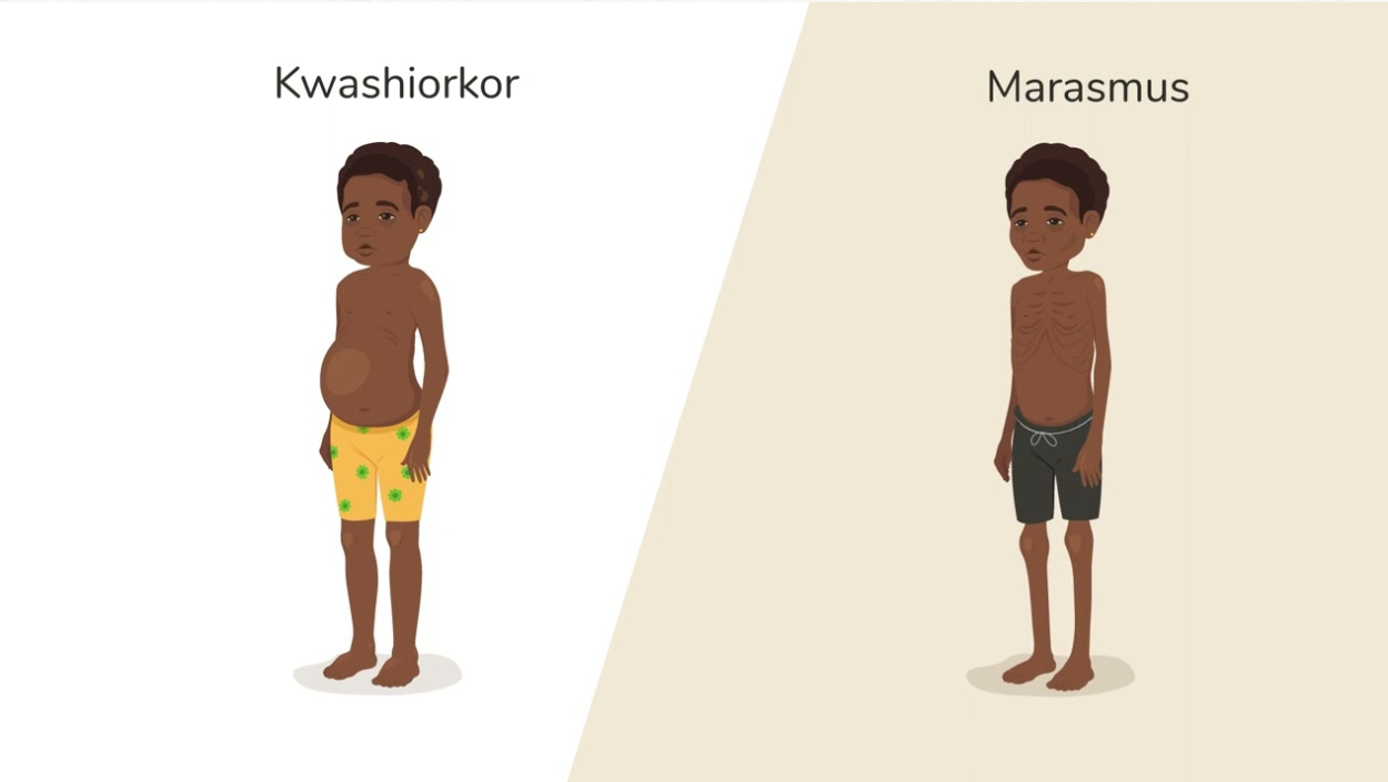 Kwashiorkor vs Marasmus